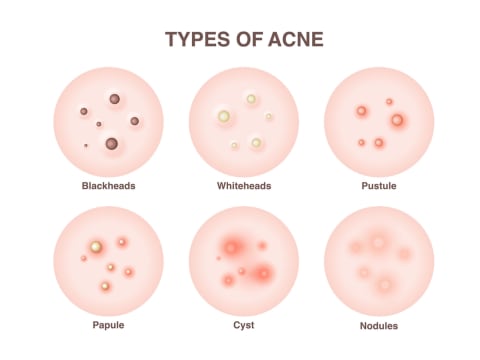 types of pimples types of pimples